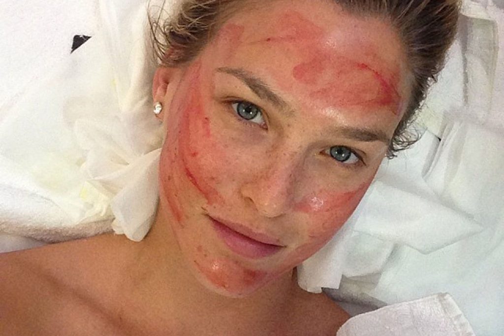La modelo Bar Rafaeli es una de las celebridades que aman en vampire facial.